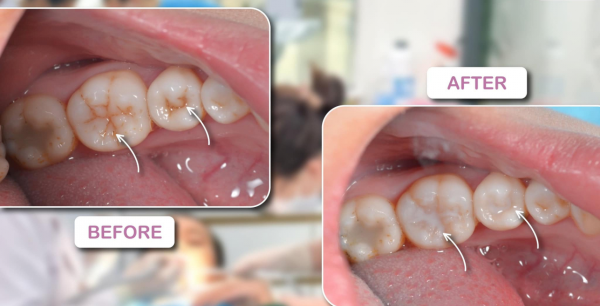 Trám bít hố rãnh bằng sealant có fluor ngừa sâu răng cho trẻ!