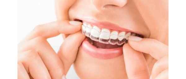 Niềng răng bằng khay trong suốt!